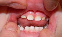 зубной налет у детей
