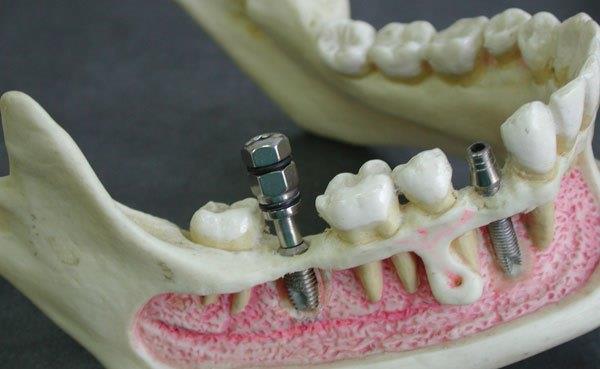 Виды имплантации зубов и возможные осложнения