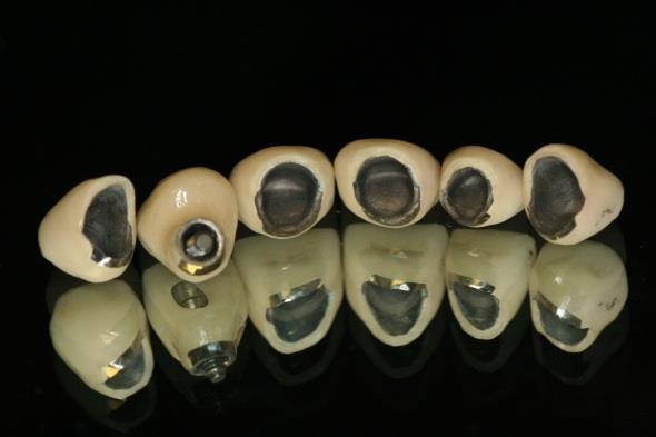 Комбинированные коронки на зубы