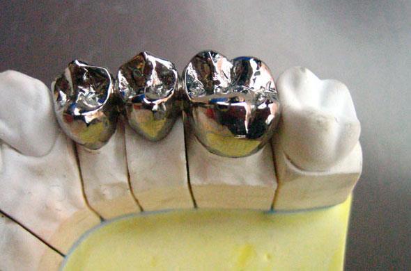 Металлические коронки на зубы
