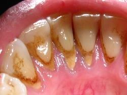 Виды и вред зубных отложений