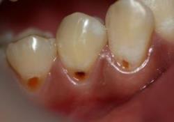 Причины заболевания некроз зубов