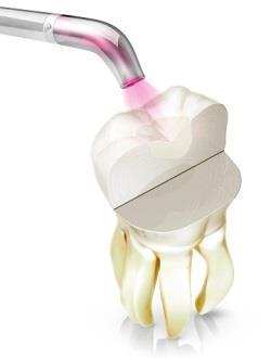 Восстановление зуба после лечение корневого канала