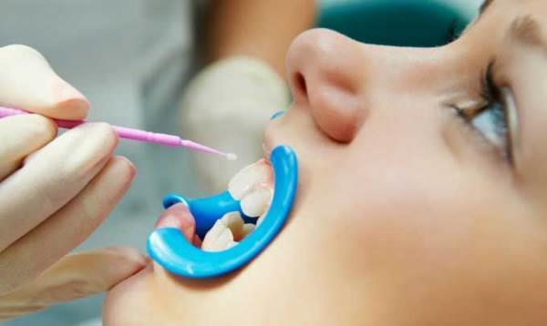 Фторирование детских зубов