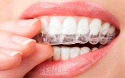 Капы для отбеливания зубов в домашних условиях