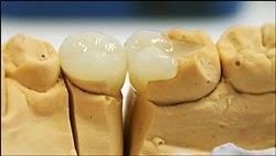 микропротзировании зубов