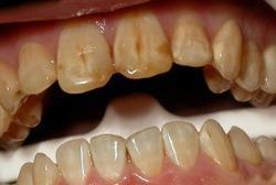 флюороз зубов