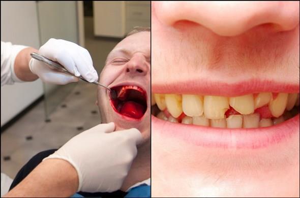 Травмы зубов: виды и лечение