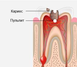 Лечение корневых каналов: пломбирование и восстановление зуба