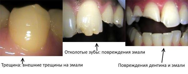Повреждение зуба, что от него ожидать, и что делать?