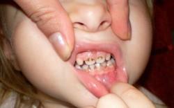 Почему чернеют зубы у ребенка