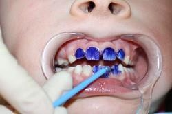 Серебрение молочных зубов