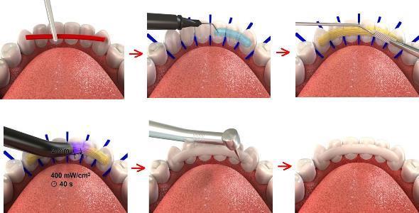 шинирование подвижных зубов