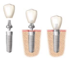 Зубные инпланты