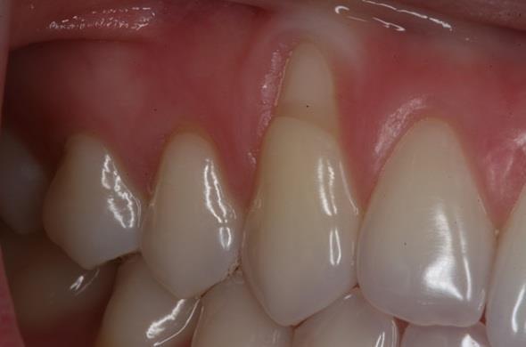 Оголение зубов: лечение