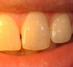 Что может стать причиной трещины зуба