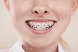 Современные методы коррекции зубов