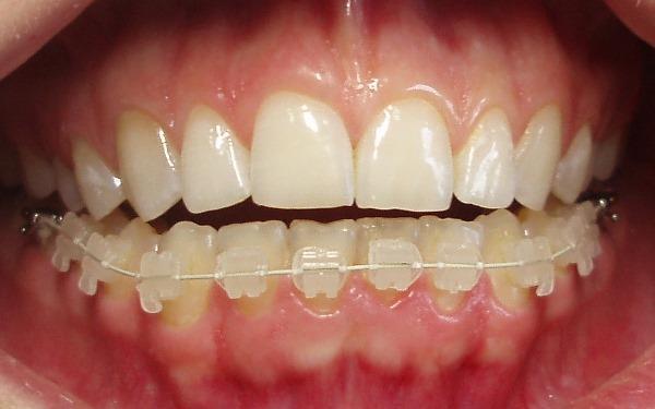 Керамические брекет-системы для выравнивания зубов