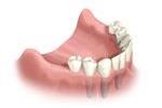 Импланты для замещения зубного ряда