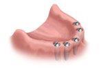 Импланты для замещения зубного ряда