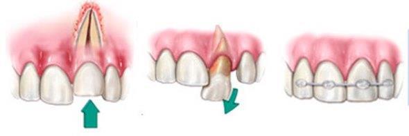 Подвижность зубов: степени, причины и лечение
