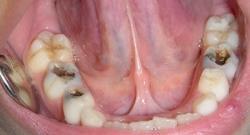 Причины пульпита молочных зубов