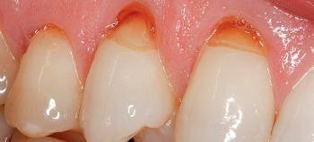 Причины оголения зубов