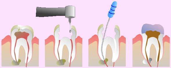 Основные этапы лечения зубных каналов