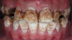 Причины заболевания Флюороз зубов