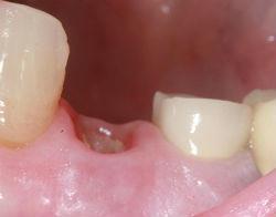 Чем полоскать рот после удаления зуба