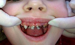 лечение гнилых зубов