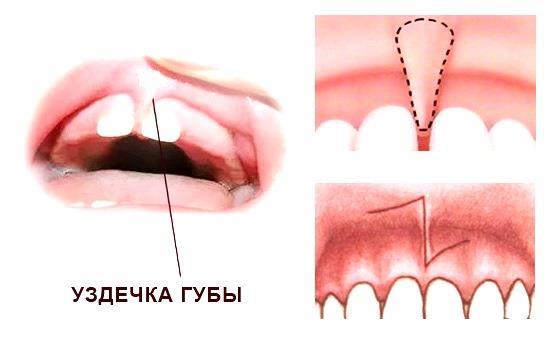 Подрезание верхней уздечки губы у ребенка