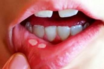 Как выглядит афтозный стоматит в полости рта?