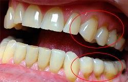 Клиновидный дефект зубов симптоматика