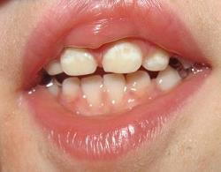 Белые пятна на молочных зубах