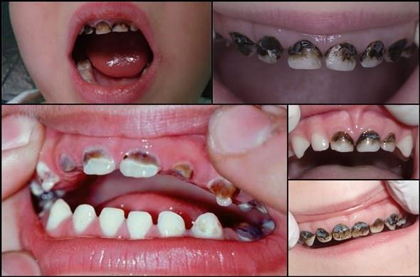 Серебрение зубов последствия