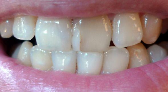 Что чувствуют пациенты с трещинами на зубах
