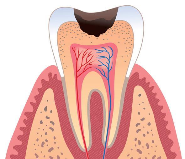 Почему болят зубы. Средний кариес