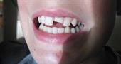 Что такое наращивание зубов и кому нужна эта процедура?