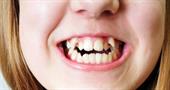 Что делать, если у ребенка молочный зуб не выпал а коренной растет?
