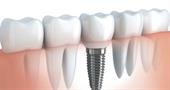 Типы зубных имплантов
