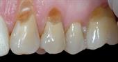 Клиновидный дефект зубов: причины, лечение и профилактика