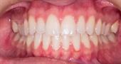 Как лечить эрозию зубной эмали?