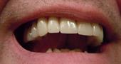 Как осуществляется восстановление эмали зубов?