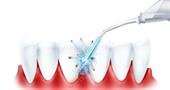 Чистка зубов водой под давлением в домашних условиях. Как выбрать ирригатор для полости рта?