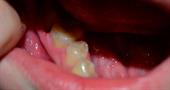 Причины возникновения болей в деснах после удаления зуба и помощь в домашних условиях