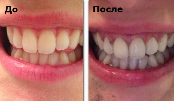 Отбеливание зубов активированным углем: фото до и после
