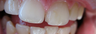 Что вызывает разрушение зуба?