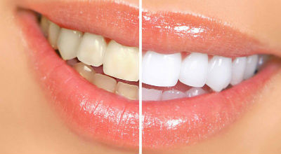 Какой самый распространенный побочный эффект от отбеливания зубов?