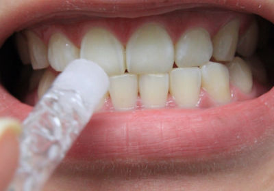 Какая из этих субстанций безопасна для домашнего отбеливания зубов?
